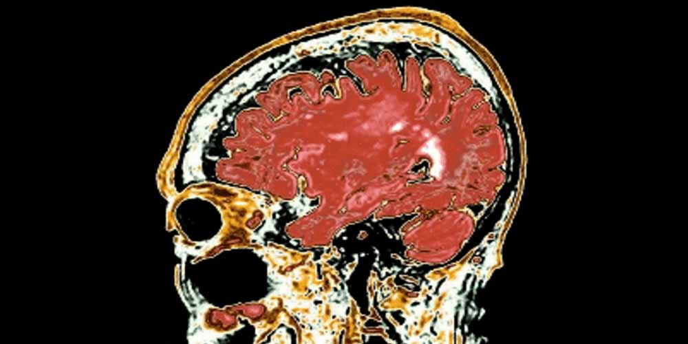 brain scan showing signs of Alzheimer's disease